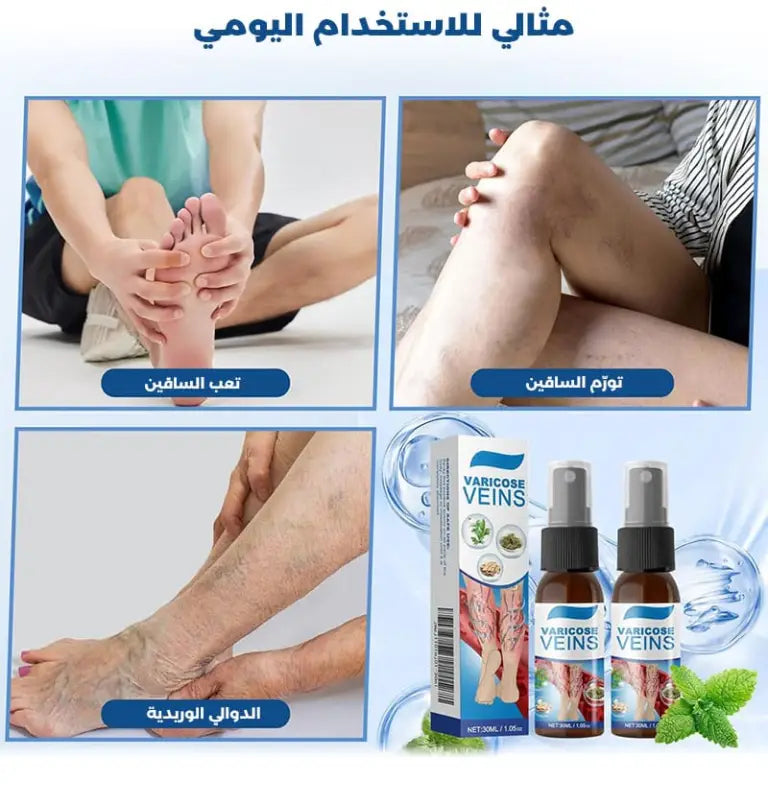 رذاذ علاج الدوالي الوريدية
